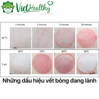 Những dấu hiệu vết bỏng đang lành