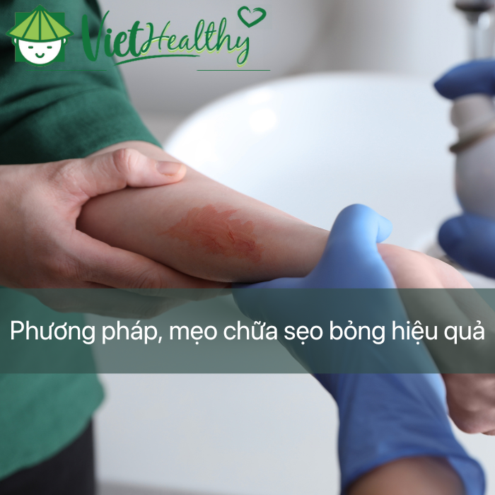 Phương pháp, mẹo chữa sẹo bỏng hiệu quả